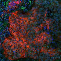 Detection of human PD-L1 (red) and Lamin